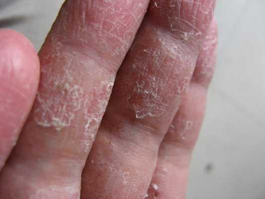 孕期手上湿疹怎么办(手上湿疹怎么治疗) 第3张 孕期手上湿疹怎么办(手上湿疹怎么治疗) 第3张