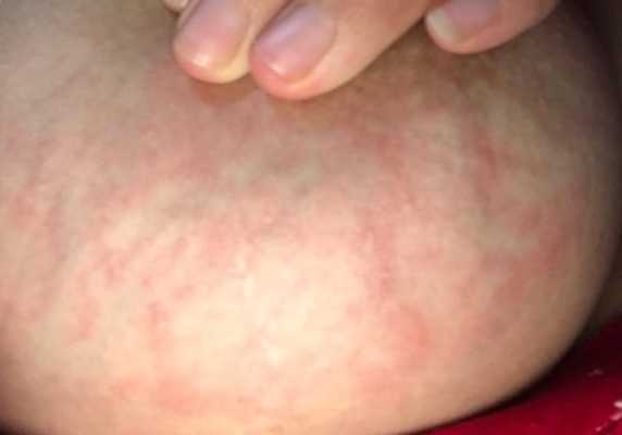 怀孕期间乳头痒(哺乳期奶头痒痒怎么回事) 第2张 怀孕期间乳头痒(哺乳期奶头痒痒怎么回事) 第2张