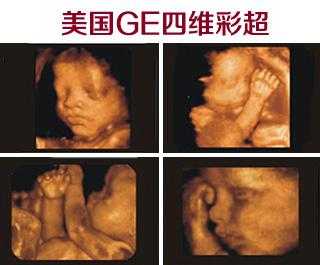 孕期二级筛查(孕妇28周到32周做二级四维彩超主要检查胎儿什么) 第2张 孕期二级筛查(孕妇28周到32周做二级四维彩超主要检查胎儿什么) 第2张