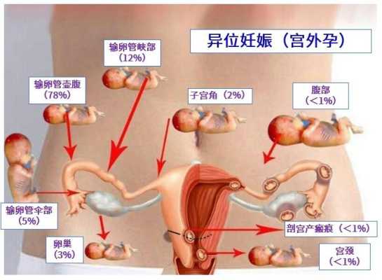 宫外孕胎儿(宫外孕胎儿能存活多久) 第1张 宫外孕胎儿(宫外孕胎儿能存活多久) 第1张