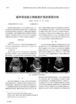 胎儿脑室大(胎儿侧脑室增宽是什么原因引起的) 第2张 胎儿脑室大(胎儿侧脑室增宽是什么原因引起的) 第2张