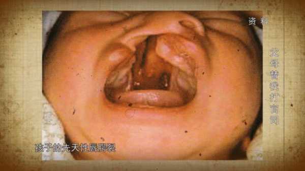 唇腭裂的孩子是怎么造成的,造成胎儿唇裂的主要原因 第2张 唇腭裂的孩子是怎么造成的,造成胎儿唇裂的主要原因 第2张