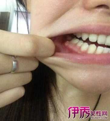 怀孕期间牙龈肿痛发炎怎么办(孕妇牙龈肿痛会自愈吗) 第2张 怀孕期间牙龈肿痛发炎怎么办(孕妇牙龈肿痛会自愈吗) 第2张
