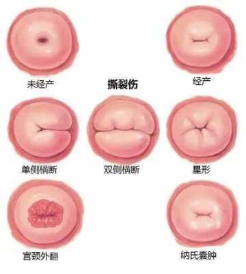 腹壁裂胎儿图片(蜘蛛腹部裂了一个口子如何挽救呀) 第3张 腹壁裂胎儿图片(蜘蛛腹部裂了一个口子如何挽救呀) 第3张