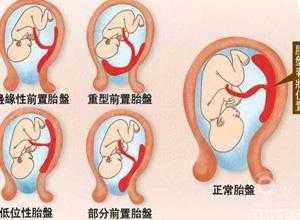 前壁胎儿图片(胎盘前壁与胎动有关系吗) 第1张 前壁胎儿图片(胎盘前壁与胎动有关系吗) 第1张