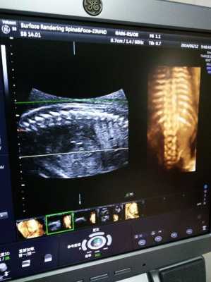 脊柱呈串珠状排列什么意思,男胎儿脊柱图片高清 第2张 脊柱呈串珠状排列什么意思,男胎儿脊柱图片高清 第2张