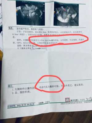 孕期左侧囊肿（左侧附件区囊肿怎么治）  第2张