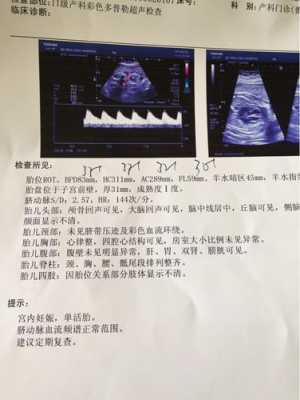怀孕33周胎儿彩超(怀孕33周胎儿彩超) 第2张 怀孕33周胎儿彩超(怀孕33周胎儿彩超) 第2张