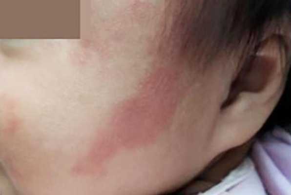 孕期查胎记(孕妇总是担心宝宝畸形,还会担心脸上长胎记?胎记是怎样形成的) 第2张 孕期查胎记(孕妇总是担心宝宝畸形,还会担心脸上长胎记?胎记是怎样形成的) 第2张