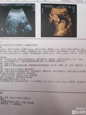 产检nf是什么,孕期nf检查是什么检查 第3张 产检nf是什么,孕期nf检查是什么检查 第3张