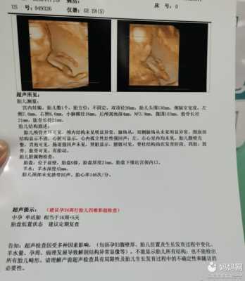 产检nf是什么,孕期nf检查是什么检查 第2张 产检nf是什么,孕期nf检查是什么检查 第2张