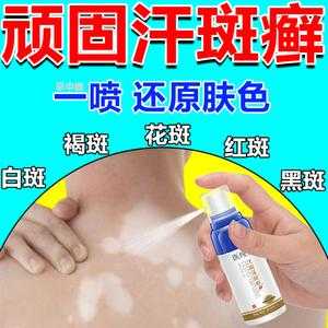 孕妇身上长了花斑癣怎么办,孕期长汗斑可以用药吗 第1张 孕妇身上长了花斑癣怎么办,孕期长汗斑可以用药吗 第1张