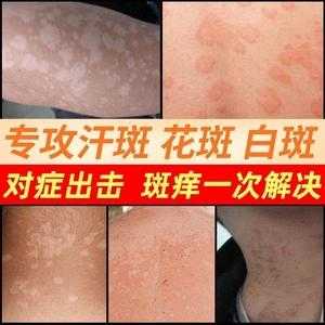 孕妇身上长了花斑癣怎么办,孕期长汗斑可以用药吗 第2张 孕妇身上长了花斑癣怎么办,孕期长汗斑可以用药吗 第2张