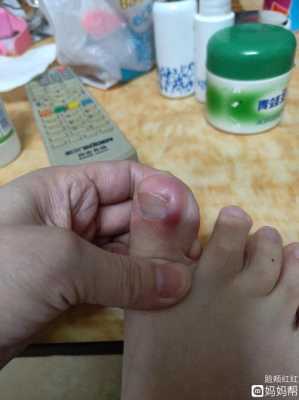 孕期脚趾痛(孕期脚趾痛什么原因) 第2张 孕期脚趾痛(孕期脚趾痛什么原因) 第2张