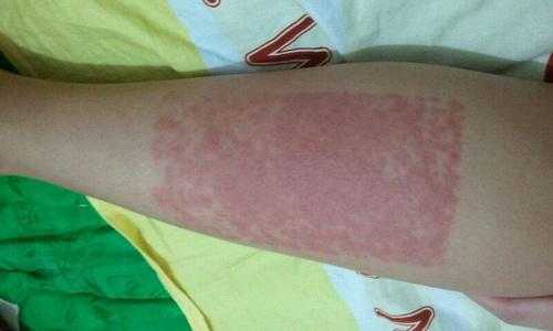 孕期腿过敏(孕期腿过敏怎么办) 第1张 孕期腿过敏(孕期腿过敏怎么办) 第1张
