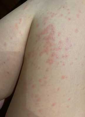 孕期腿过敏(孕期腿过敏怎么办) 第2张 孕期腿过敏(孕期腿过敏怎么办) 第2张