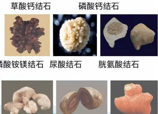 孕妇肾结石伴又肾积水如何治疗?孕中期时候，对胎儿有什么危害,孕妇肾酸痛  第2张