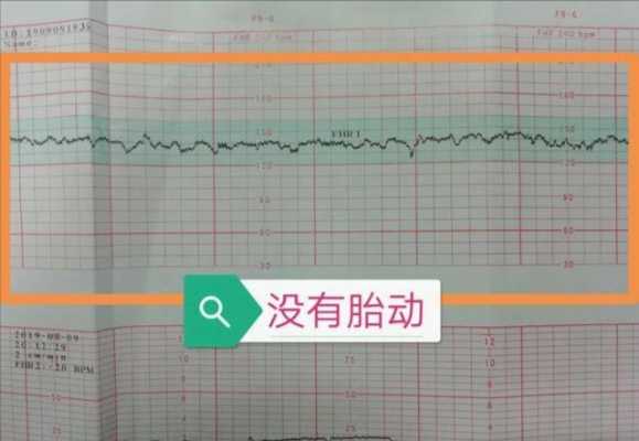 做胎心监护对胎儿有影响吗(天天做胎心监护对胎儿有影响吗) 第3张 做胎心监护对胎儿有影响吗(天天做胎心监护对胎儿有影响吗) 第3张