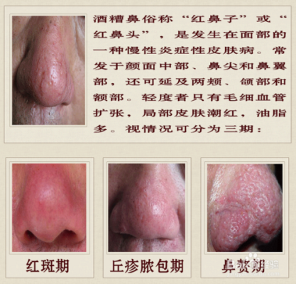 孕期红鼻头(鼻尖发红是什么原因) 第3张 孕期红鼻头(鼻尖发红是什么原因) 第3张