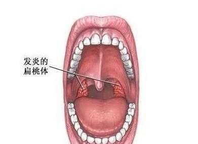 孕妇嗓子发炎肿痛怎么办,孕期嗓子肿痛发炎怎么办  第1张