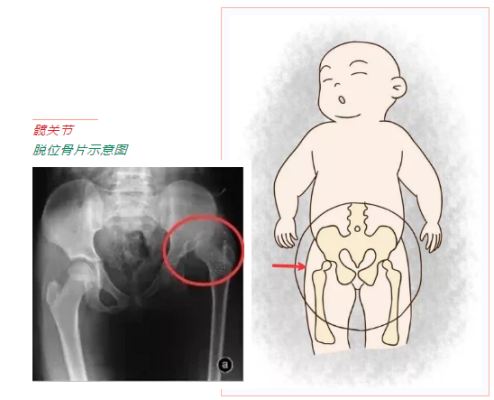 胎儿髋关节（胎儿髋关节脱位四维能发现吗）  第1张
