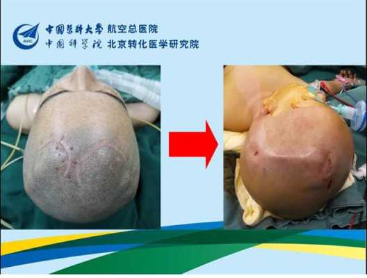 胎儿脑部积水(胎儿脑部积水是怎么引起的) 第2张 胎儿脑部积水(胎儿脑部积水是怎么引起的) 第2张
