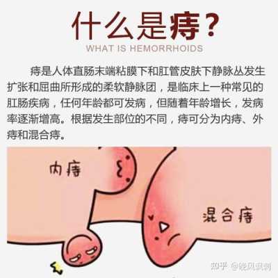 痔疮是如何产生的,孕期痔疮原因有哪些 第2张 痔疮是如何产生的,孕期痔疮原因有哪些 第2张