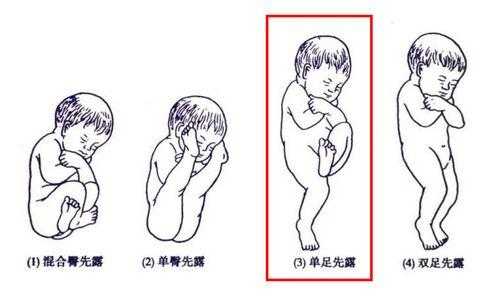 胎儿单臀(胎儿单臀先露是什么意思) 第1张 胎儿单臀(胎儿单臀先露是什么意思) 第1张