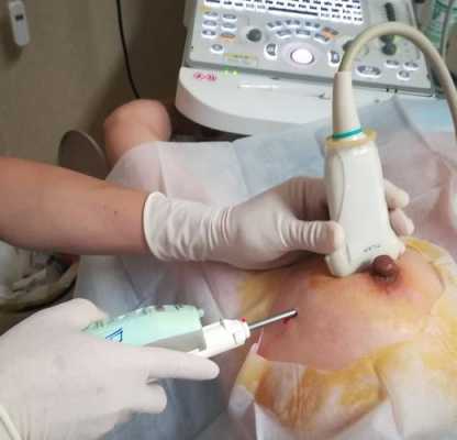 乳腺肿块微创手术前要检查什么,孕期微创检查是什么? 第1张 乳腺肿块微创手术前要检查什么,孕期微创检查是什么? 第1张
