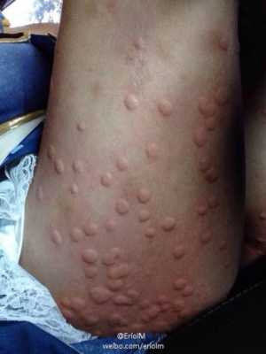 孕期能擦药吗(孕妇可以擦药吗?我被蚊子咬了,身上起了很大个包,想擦点药膏) 第2张 孕期能擦药吗(孕妇可以擦药吗?我被蚊子咬了,身上起了很大个包,想擦点药膏) 第2张