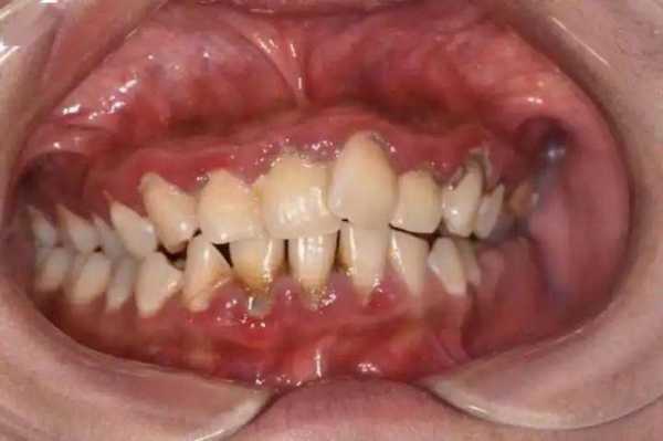 怀孕快9个月了牙出血怎么回事?牙出血是什么原因引起的呢,孕期流牙血怎么回事  第2张
