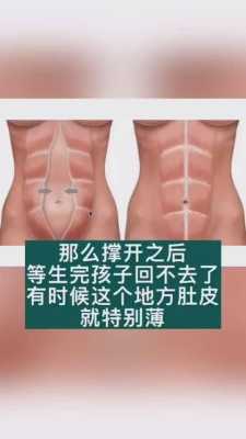孕期腹直肌（孕期腹直肌的变化图片）  第2张