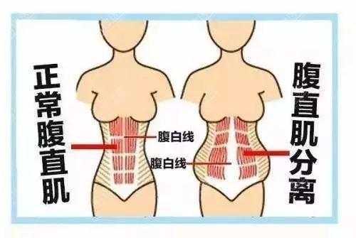 孕期腹直肌（孕期腹直肌的变化图片）  第1张