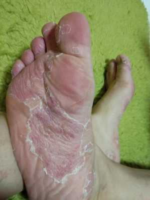 孕妇脸脱皮怎么回事,孕期脚痒脱皮脚臭怎么办 第2张 孕妇脸脱皮怎么回事,孕期脚痒脱皮脚臭怎么办 第2张