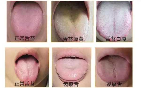 产妇舌苔厚白是怎么办?是不是体内湿气重?吃什么比较好,孕期舌苔厚白是什么原因 第1张 产妇舌苔厚白是怎么办?是不是体内湿气重?吃什么比较好,孕期舌苔厚白是什么原因 第1张