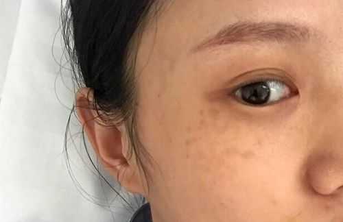 怎样消除脸上的妊娠斑,防止妊娠斑 第2张 怎样消除脸上的妊娠斑,防止妊娠斑 第2张