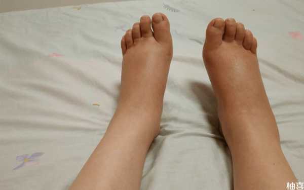 孕妇脚水肿怎么办,孕期脚大了还能恢复吗  第2张