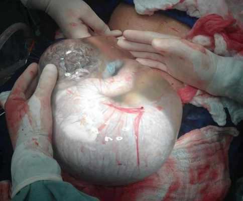剖腹产宝宝吐羊水怎么办,胎儿吐羊水是怎么回事啊 第1张 剖腹产宝宝吐羊水怎么办,胎儿吐羊水是怎么回事啊 第1张