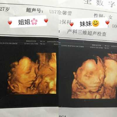 孕期三维彩超（三维彩超什么时候做）  第2张