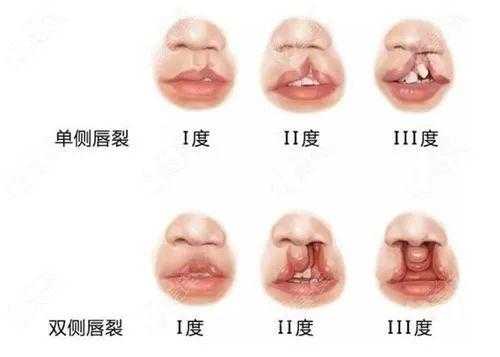 造成胎儿唇裂的原因(造成胎儿唇裂的主要原因) 第1张 造成胎儿唇裂的原因(造成胎儿唇裂的主要原因) 第1张