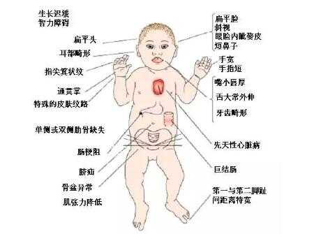 什么叫唐氏综合症,孕期综合症的表现怎么调节  第3张