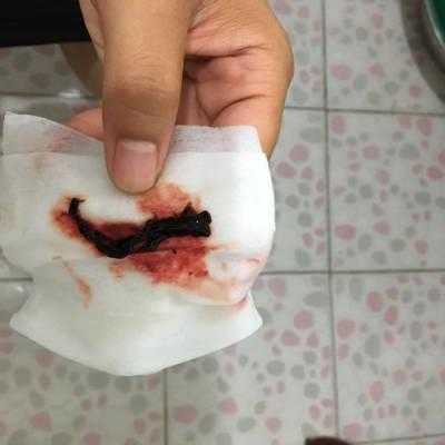 早孕有少量出血是怎么回事,怀孕期间流血块了怎么回事  第1张