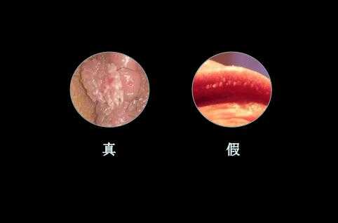 怀孕期间得了尖锐湿疣,怎么办,怀孕期间得了尖锐湿还能不能顺产 第1张 怀孕期间得了尖锐湿疣,怎么办,怀孕期间得了尖锐湿还能不能顺产 第1张