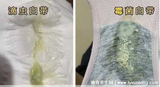 怀孕了有滴虫性阴炎怎么办,怀孕有霉菌影响胎儿吗 第1张 怀孕了有滴虫性阴炎怎么办,怀孕有霉菌影响胎儿吗 第1张