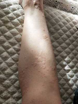 荨麻疹怀孕影响胎儿吗(孕妇身上起风团对胎儿有影响吗) 第1张 荨麻疹怀孕影响胎儿吗(孕妇身上起风团对胎儿有影响吗) 第1张
