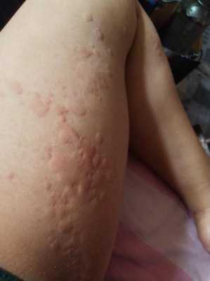 荨麻疹怀孕影响胎儿吗(孕妇身上起风团对胎儿有影响吗) 第2张 荨麻疹怀孕影响胎儿吗(孕妇身上起风团对胎儿有影响吗) 第2张