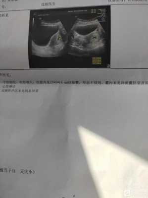 孕囊形态欠规则小孩能要吗,孕囊不规则胎儿能要吗胎芽正常 第1张 孕囊形态欠规则小孩能要吗,孕囊不规则胎儿能要吗胎芽正常 第1张