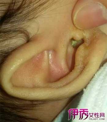 十个月宝宝中耳炎是什么症状,孕妇中耳炎会影响胎儿吗视频 第1张 十个月宝宝中耳炎是什么症状,孕妇中耳炎会影响胎儿吗视频 第1张