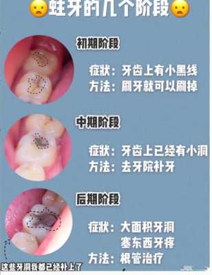 孕妇龋齿很严重咋办,孕期龋齿疼的厉害怎么办 第1张 孕妇龋齿很严重咋办,孕期龋齿疼的厉害怎么办 第1张