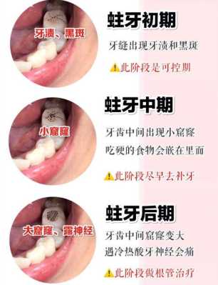 孕妇龋齿很严重咋办,孕期龋齿疼的厉害怎么办 第2张 孕妇龋齿很严重咋办,孕期龋齿疼的厉害怎么办 第2张